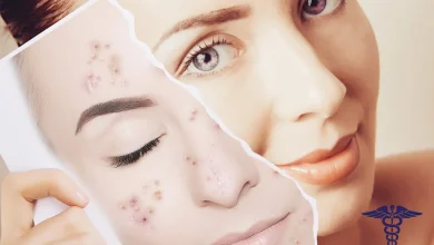 تزریق ژل جای جوش شیراز