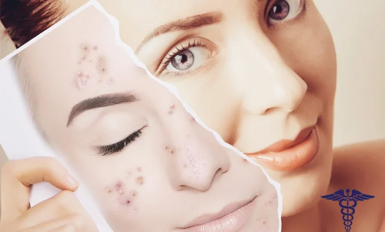 تزریق ژل جای جوش شیراز