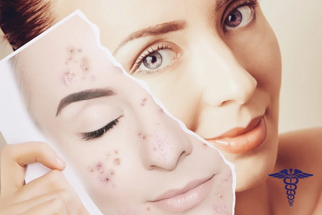 تزریق ژل جای جوش شیراز