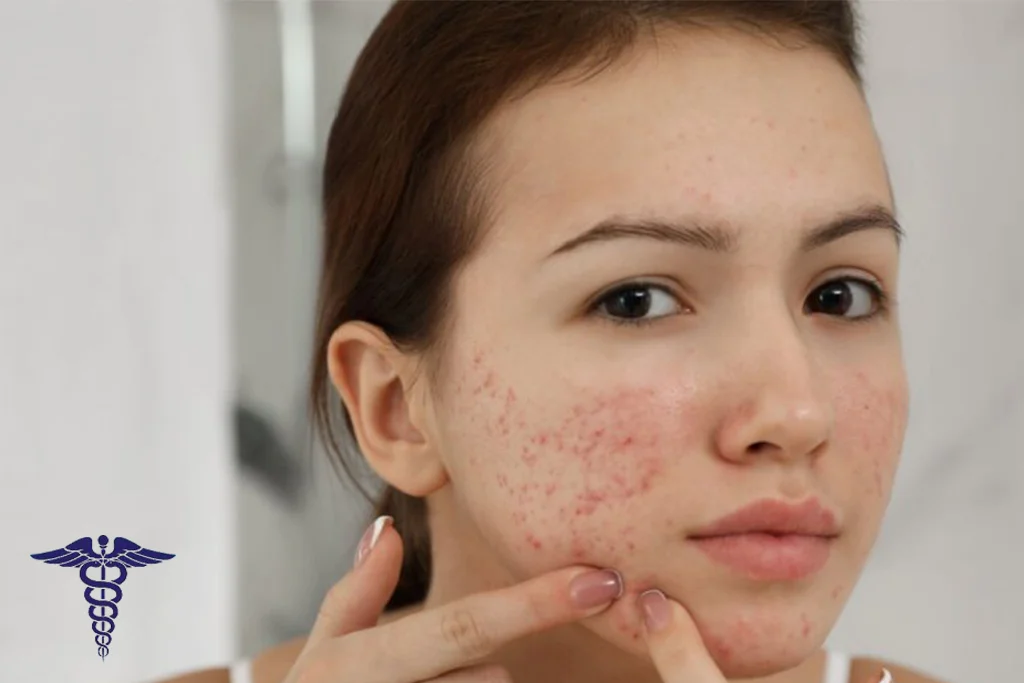 تزریق ژل جای جوش شیراز