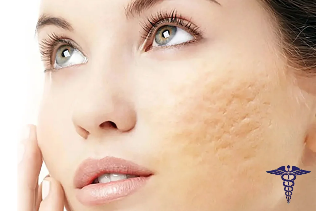 تزریق ژل جای جوش شیراز