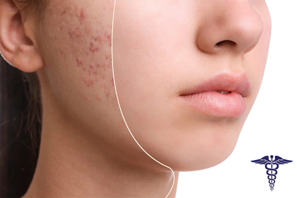 تزریق ژل جای جوش شیراز