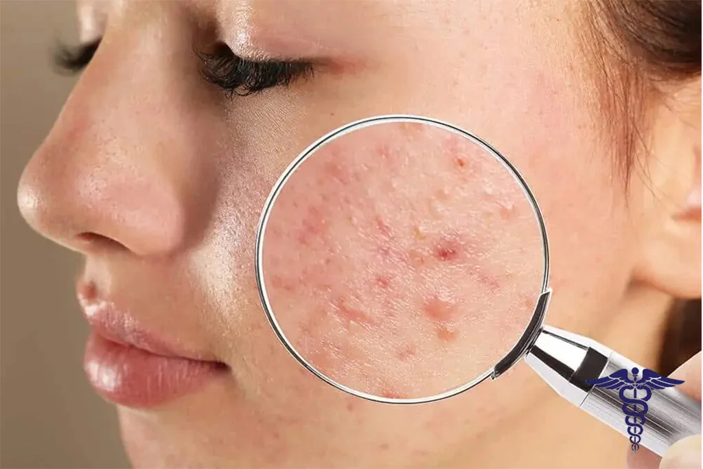 تزریق ژل جای جوش شیراز