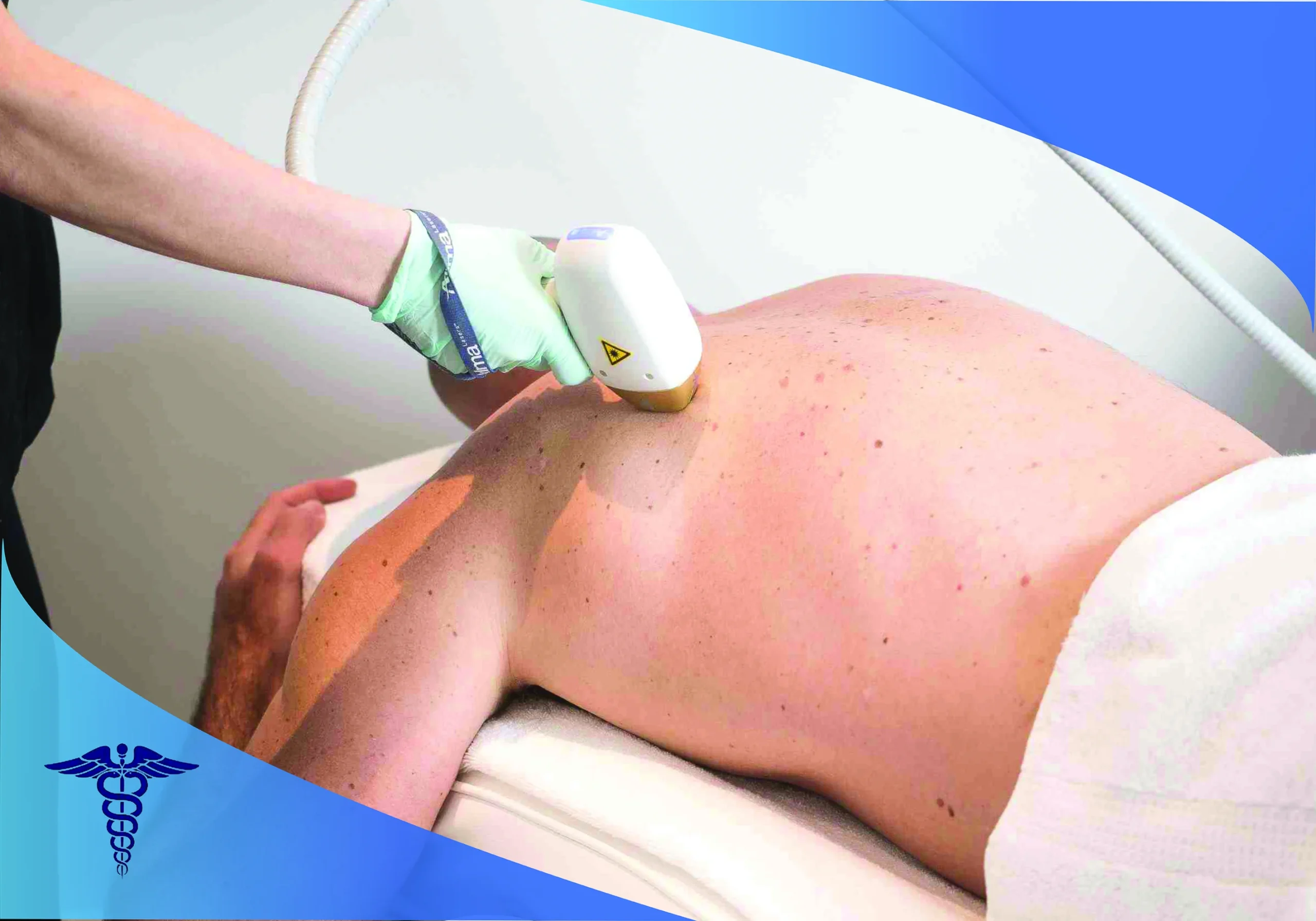 چگونگی عملکرد لیزر سوپرانو تیتانیوم در شیراز