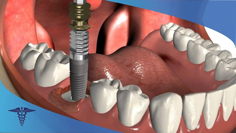 مراقبت های بعد از جراحی اصلاحی فک
