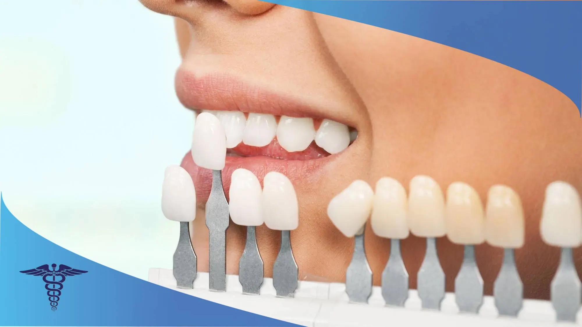 لمینت دندان شیراز پیش کی انجام بدیم؟
