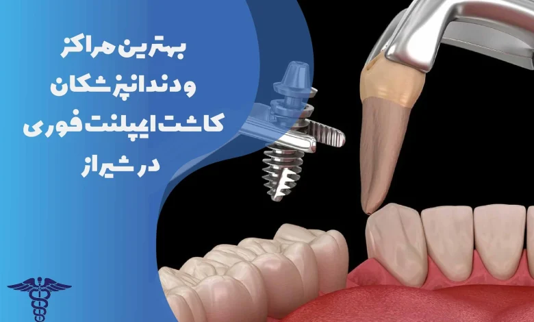 13 تا از مراکز کاشت ایمپلنت فوری در شیراز