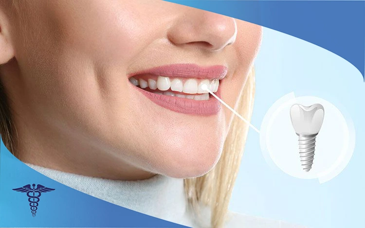 ایمپلنت دندانی چیست؟