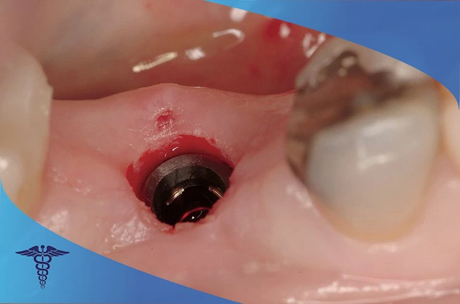 نتیجه جراحی ارتوگناتیک در شیراز