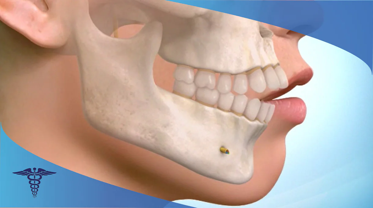 کاندیدای مناسب برای جراحی ارتوگناتیک در شیراز