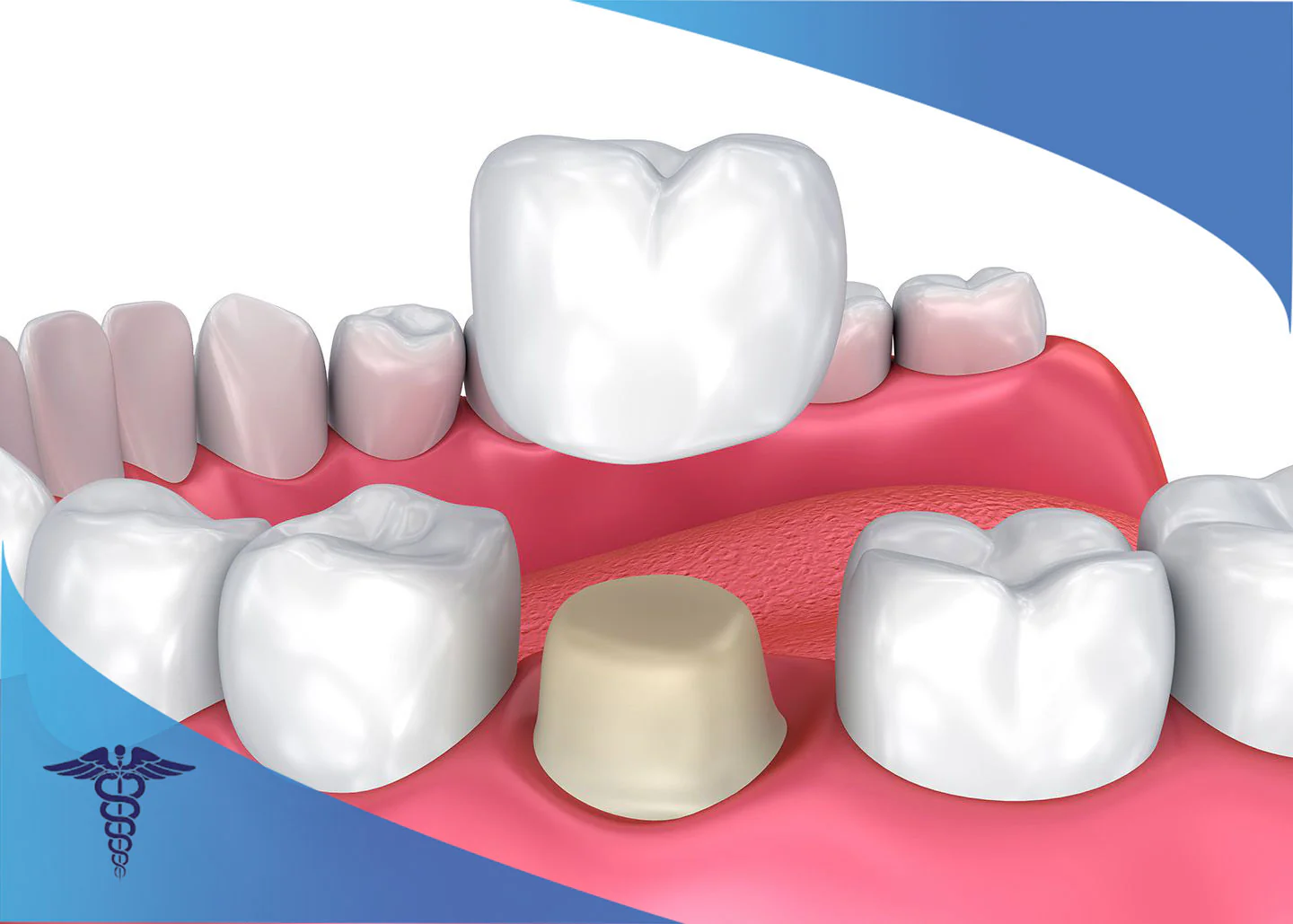 پروتز دندان چیست و چه کاربردی دارد؟