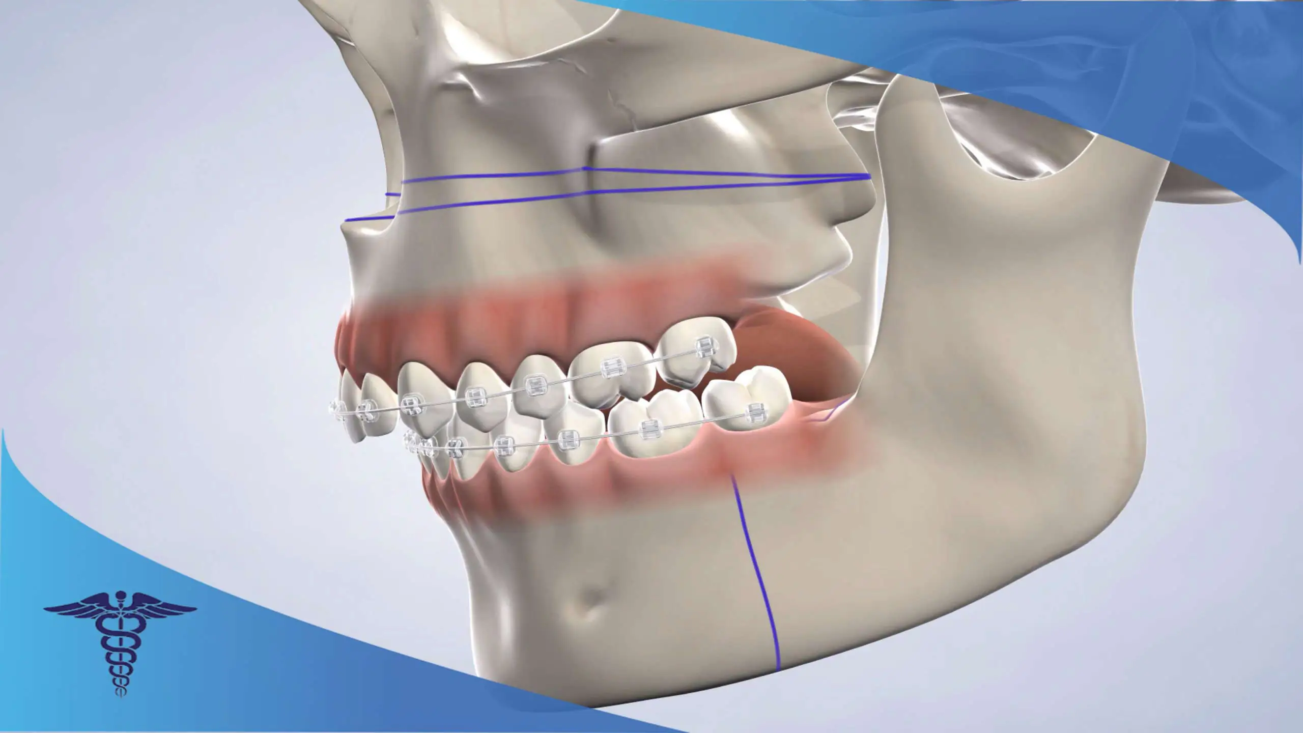 هزینه جراحی فک جلو و اهداف مهم آن
