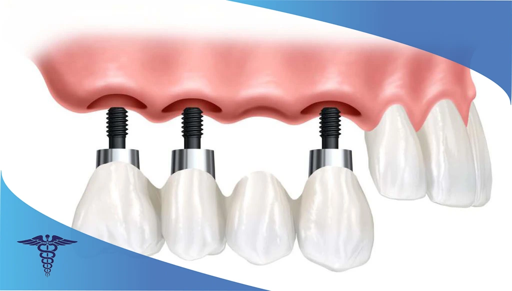 جراحی زیبایی فک بالا برای رفع ناترازی
