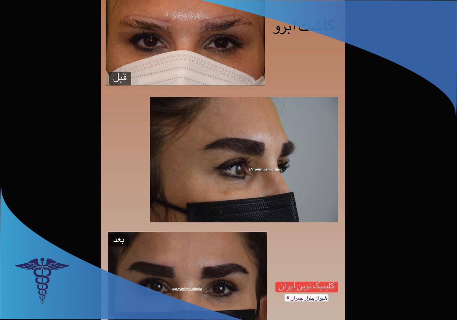 نمونه کار کاشت ابرو در کلینیک نوین ایران