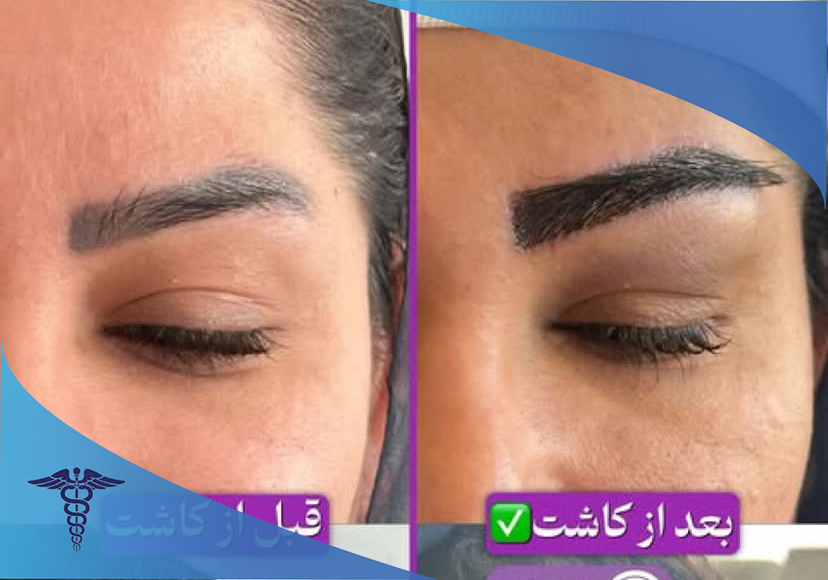 نمونه کاشت ابرو در کلینیک تخصصی لیان