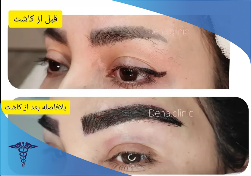 نمونه کاشت ابرو در کلینیک تخصصی دنا