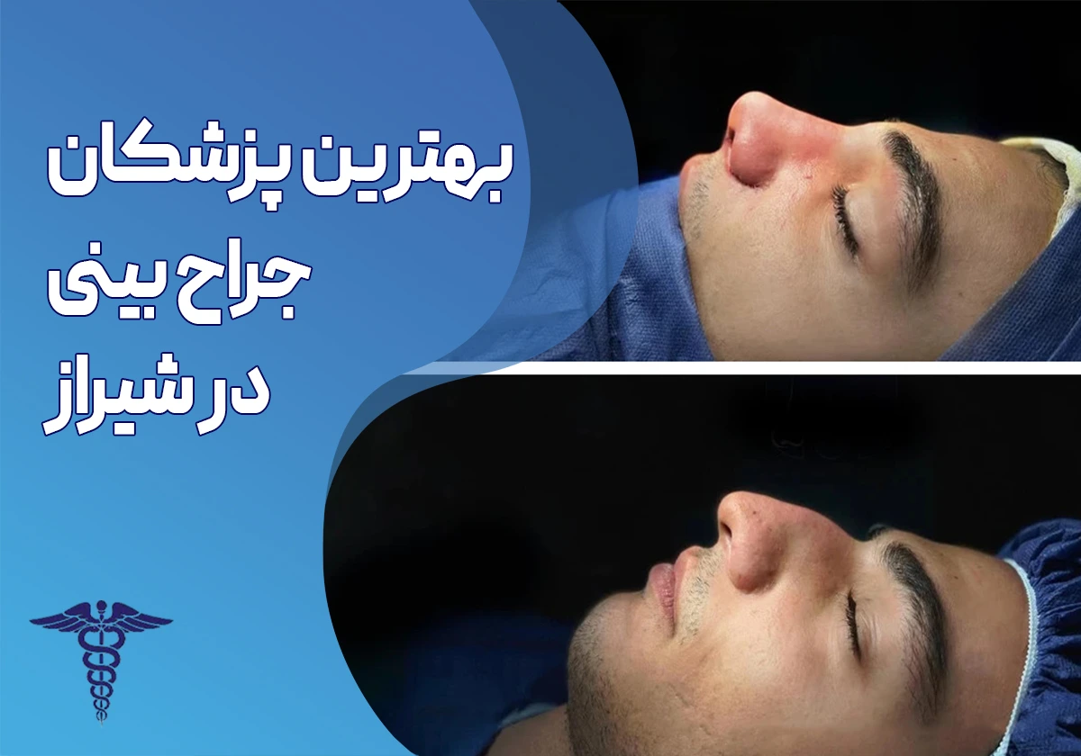 بهترین پزشکان جراح بینی در شیراز