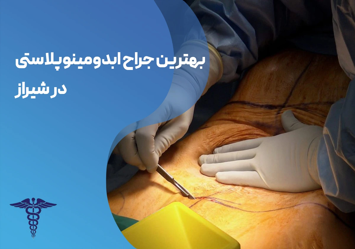 ابدومینوپلاستی در شیراز