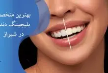 لیست بهترین متخصص بلیچینگ دندان در شیراز
