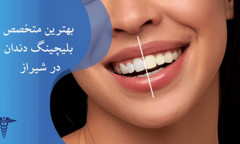 لیست بهترین متخصص بلیچینگ دندان در شیراز