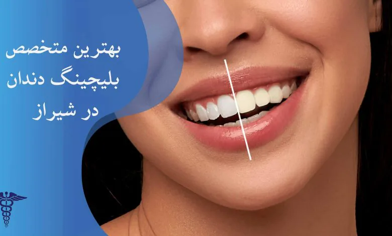 لیست بهترین متخصص بلیچینگ دندان در شیراز
