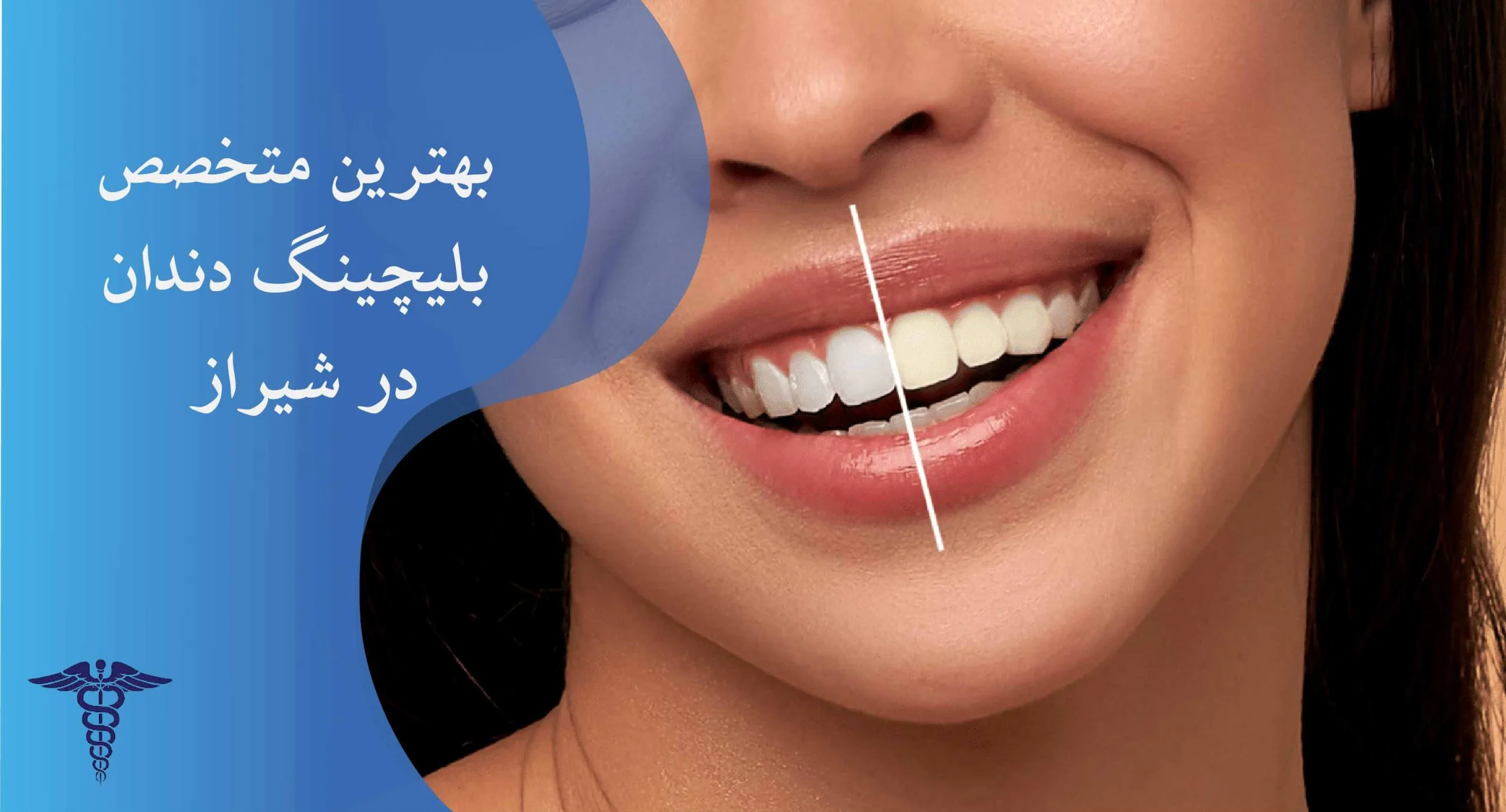 لیست بهترین متخصص بلیچینگ دندان در شیراز