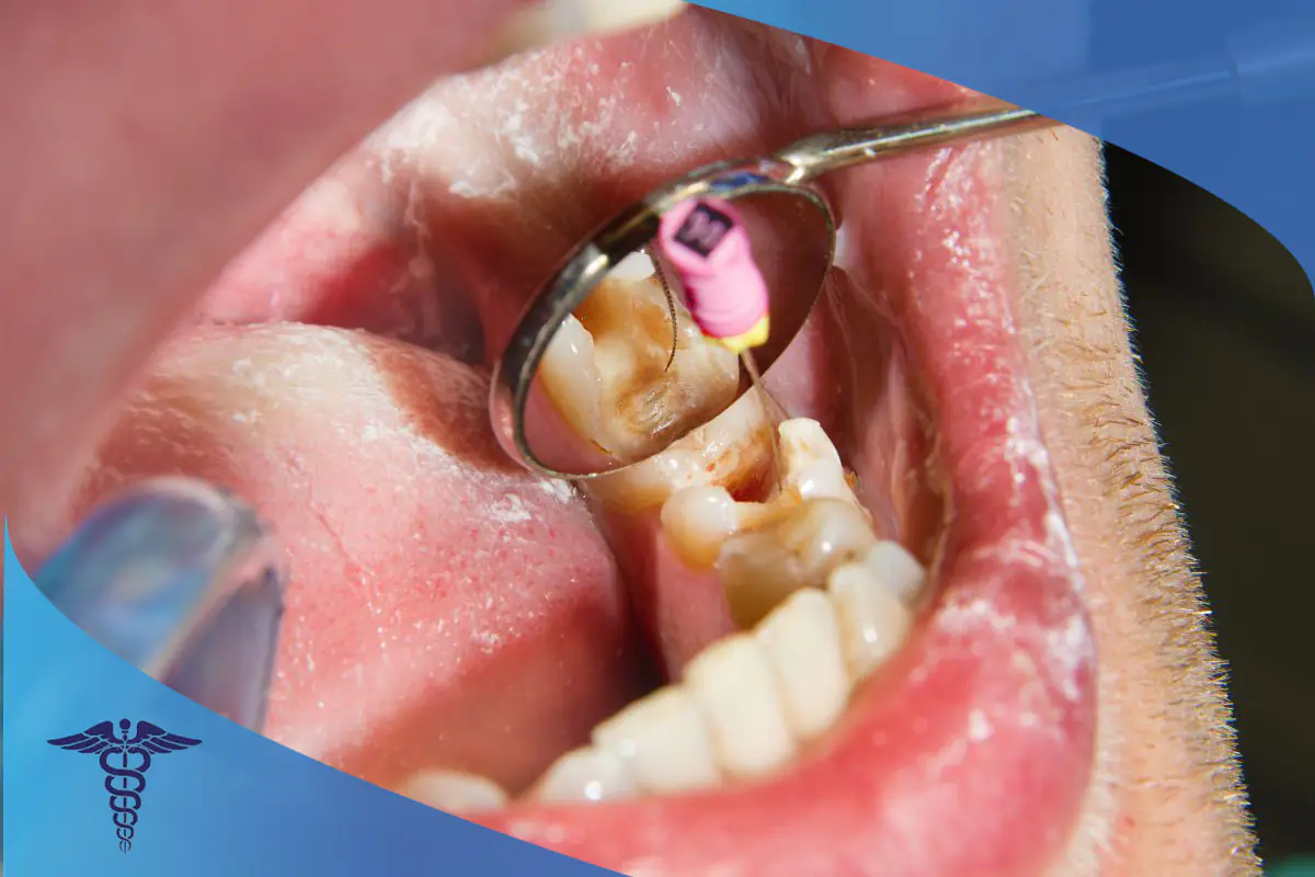 چه زمانی به متخصص عصب کشی در شیراز مراجعه کنیم؟