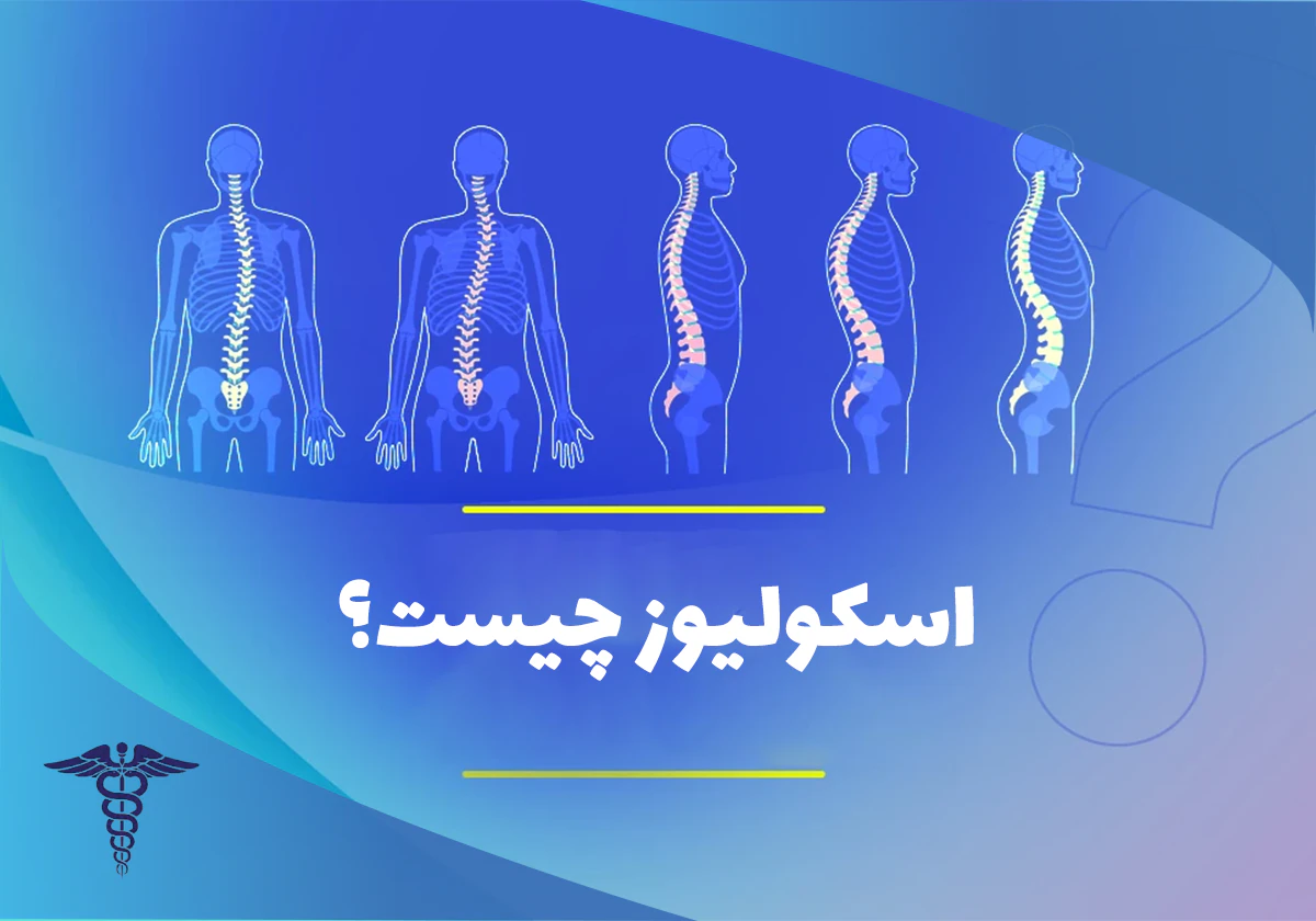 اسکولیوز چیست؟