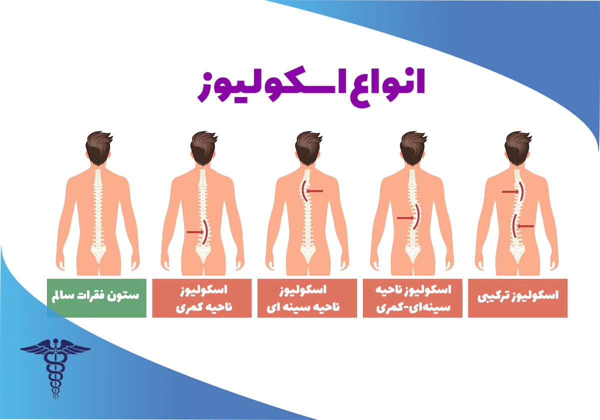انواع اسکولیوز از نظر بهترین دکتر ستون فقرات در شیراز