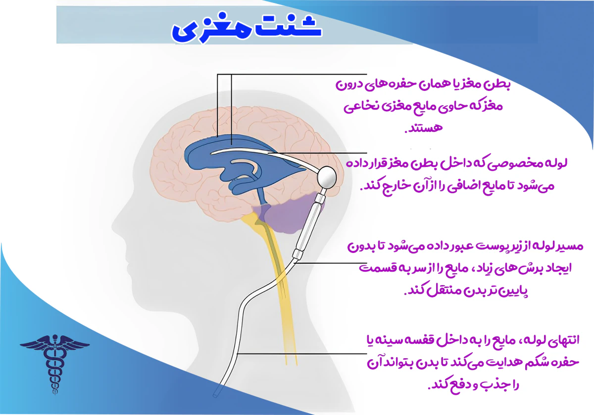 عمل جراحی شنت مغزی