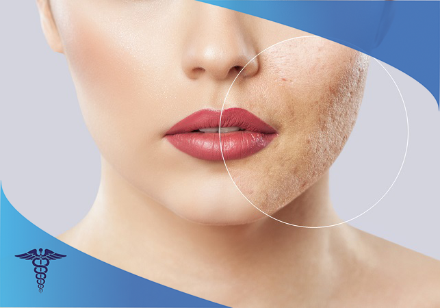 درمان اسکار در صدرا شیراز