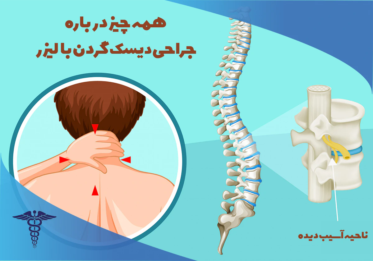عمل پارگی دیسک گردن با لیزر