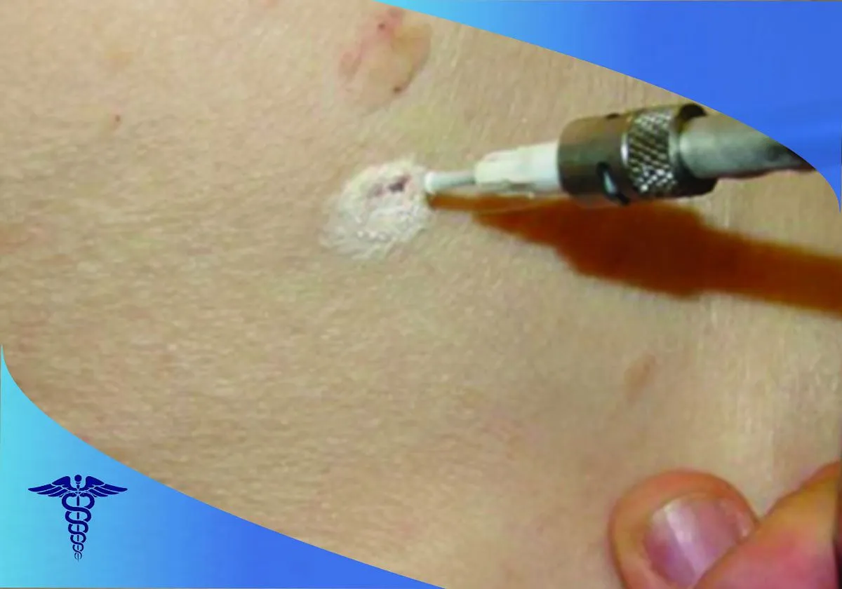 درمان قعطی زگیل در شیراز