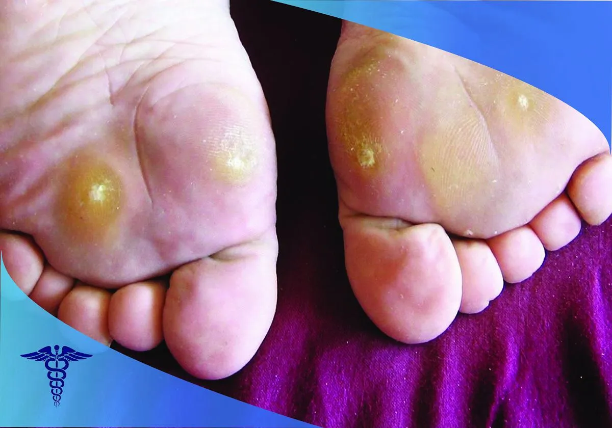 درمان زگیل پا در شیراز