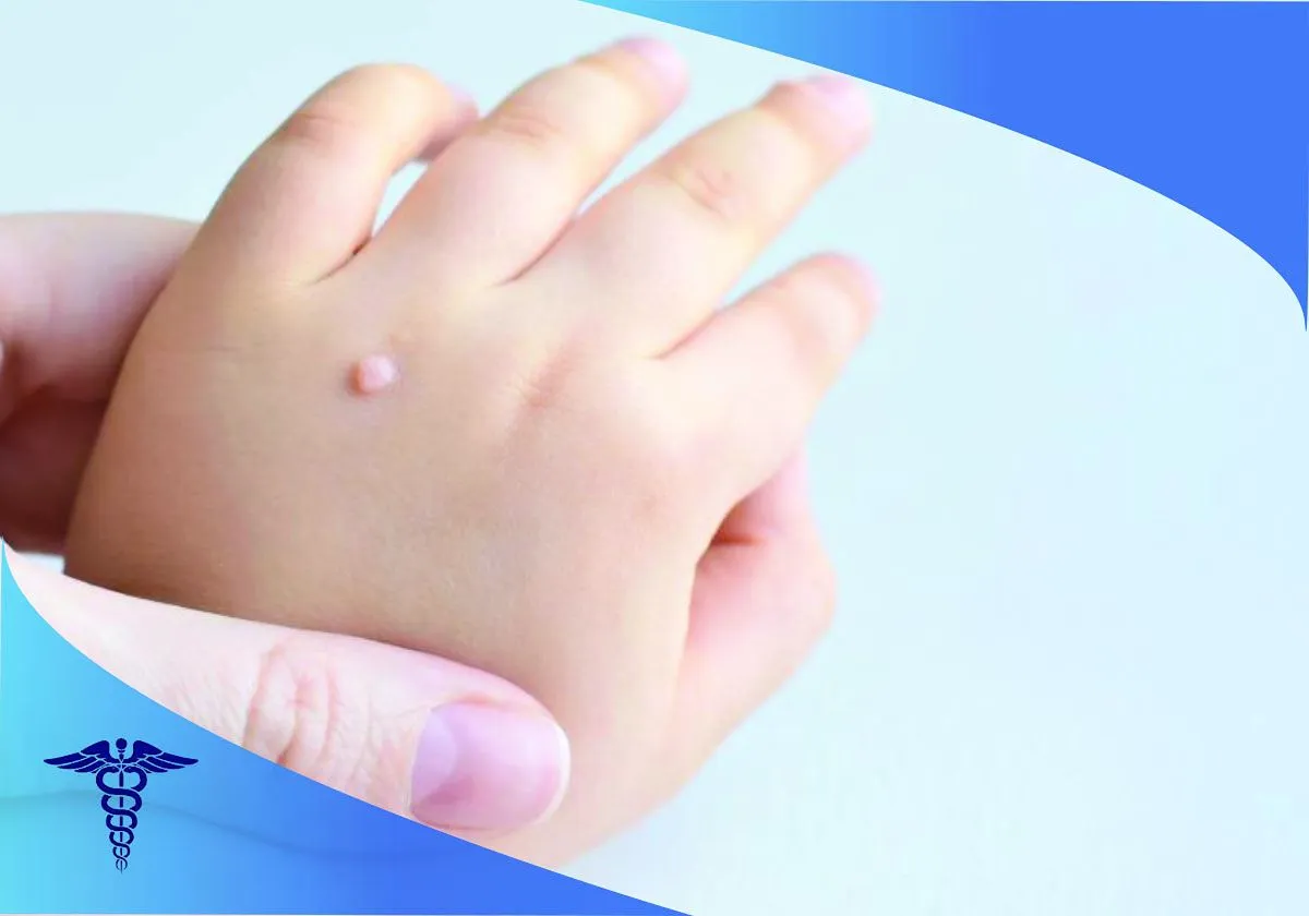 قیمت لیزر زگیل در شیراز