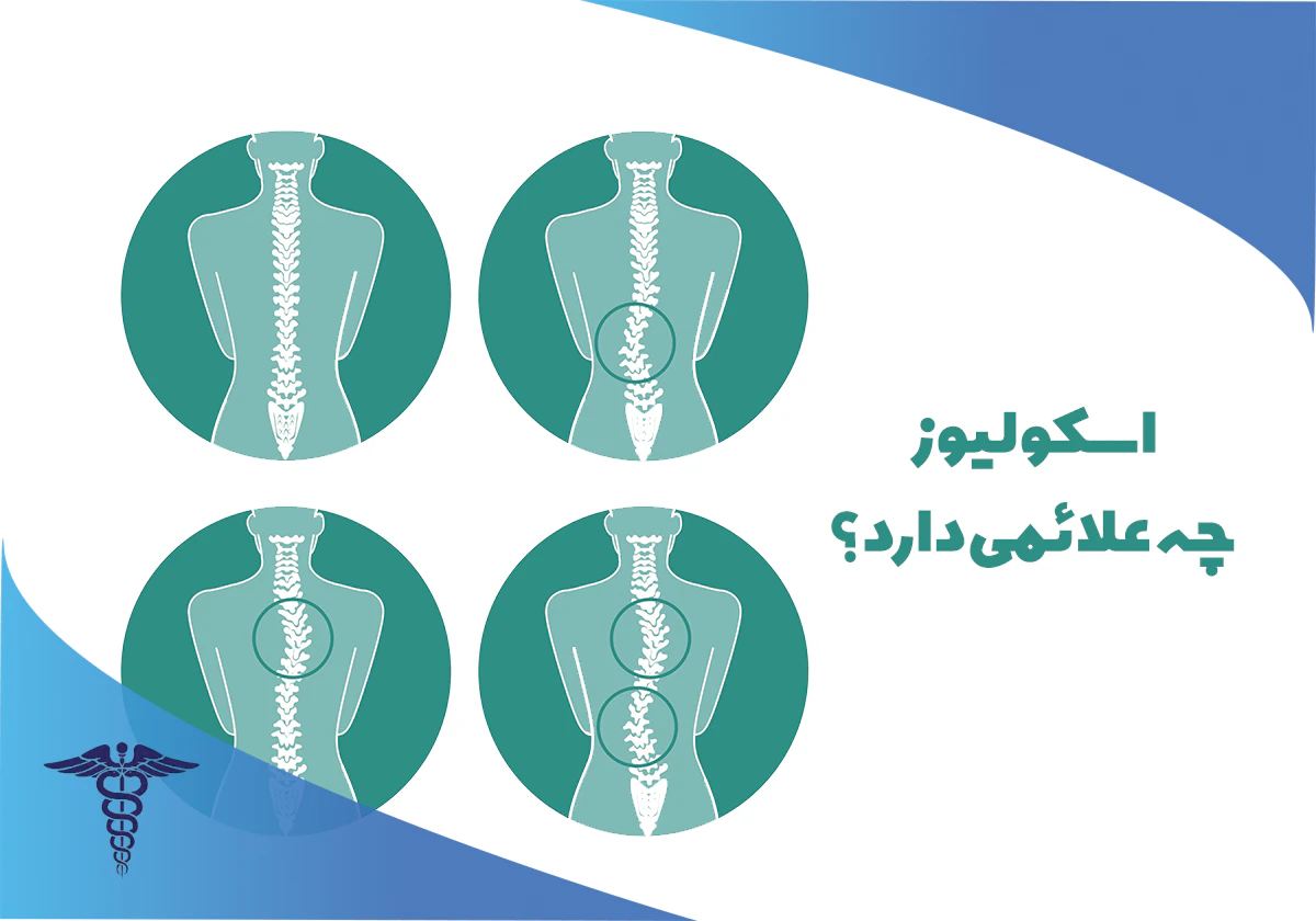 با علائم اسکولیوز آشنا شوید