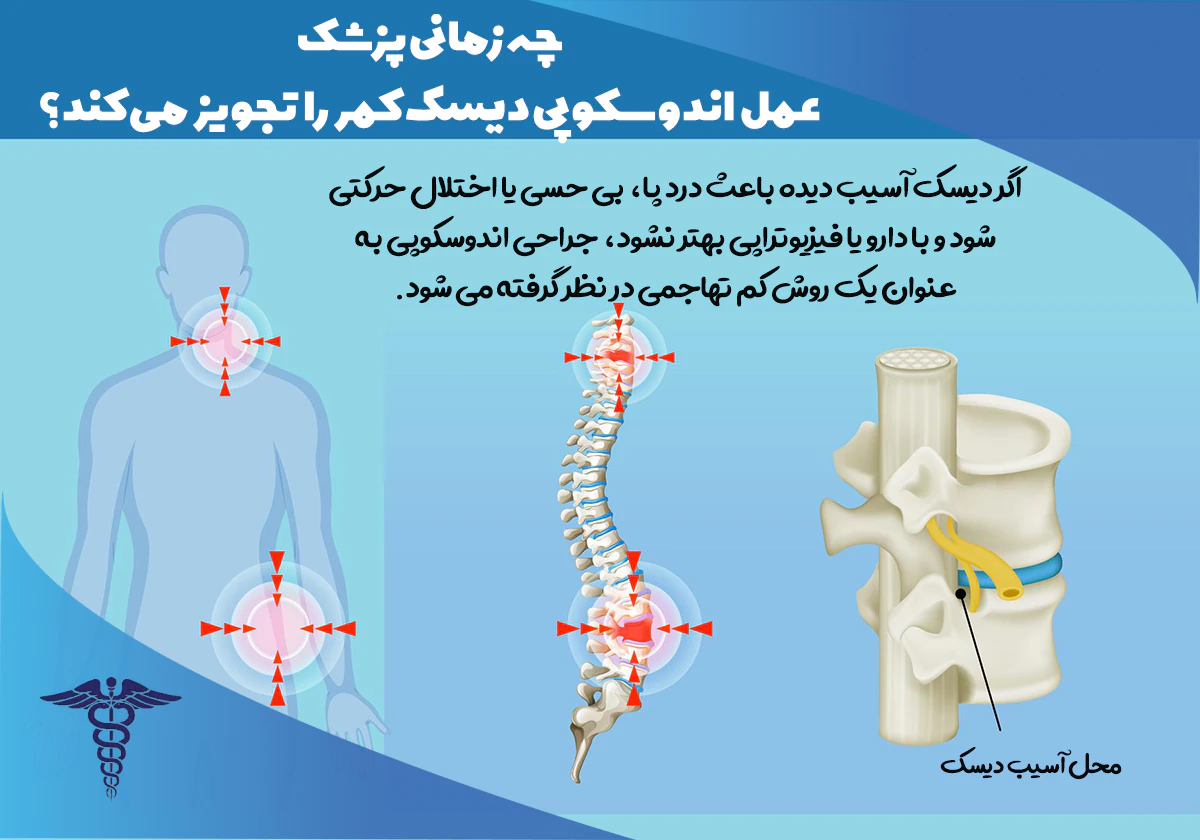 چه زمانی باید به مرکز اندوسکوپی دیسک کمر شیراز مراجعه کنیم؟