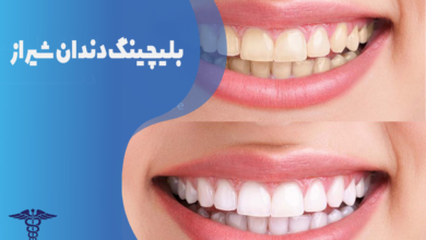 بلیچینگ دندان شیراز