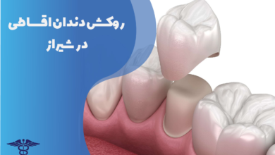 روکش دندان اقساطی در شیراز