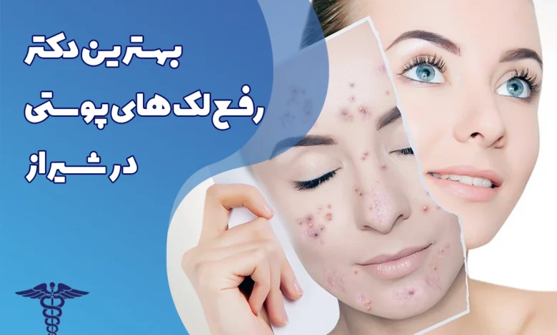 20 تا بهترین دکتر رفع لک های پوستی در شیراز