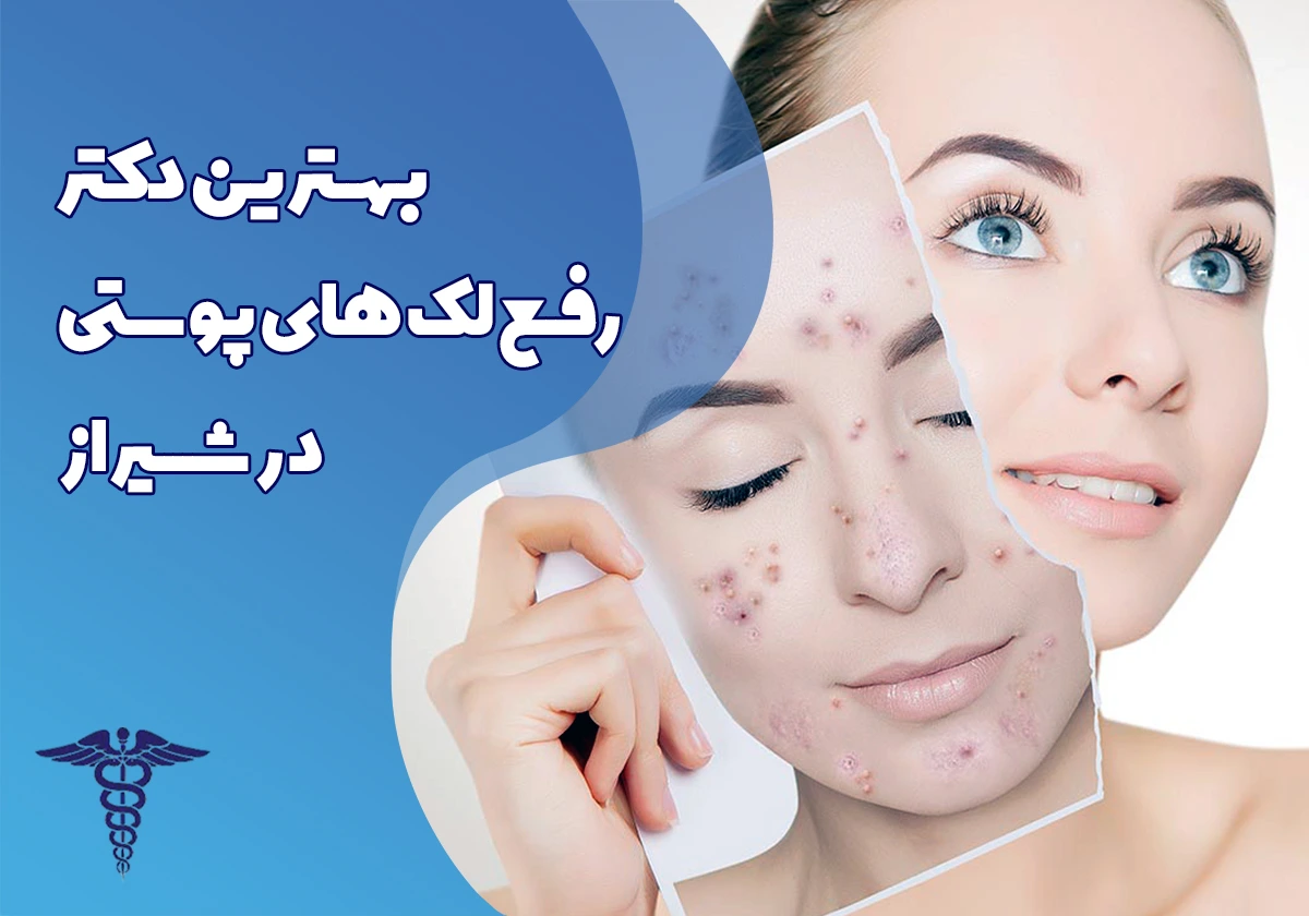 20 تا بهترین دکتر رفع لک های پوستی در شیراز