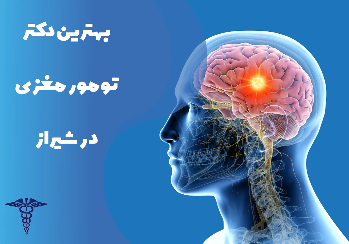 معرفی بهترین دکتر تومور مغزی در شیراز