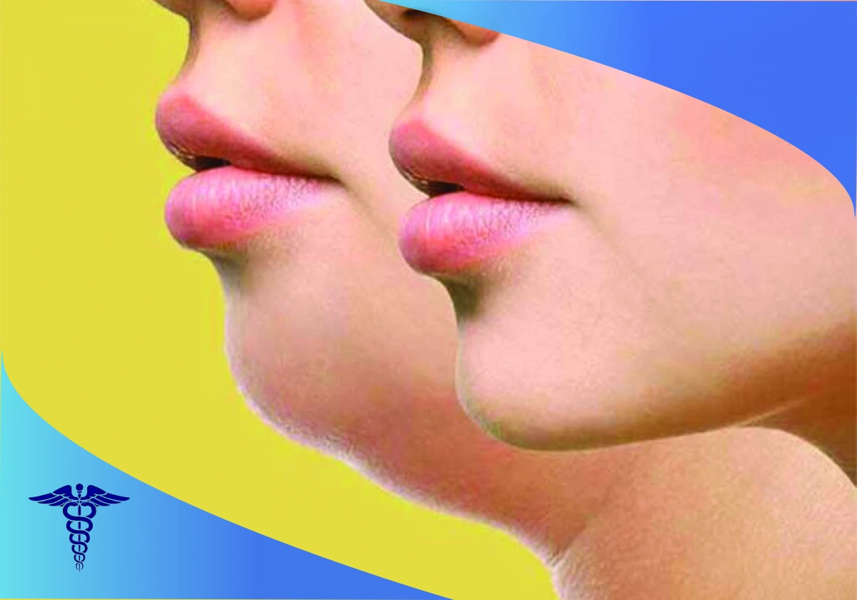 بهترین دکتر زاویه سازی صورت در شیراز