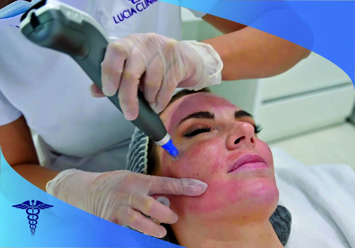 بهترین دکتر میکرونیدلینگ صورت در شیراز