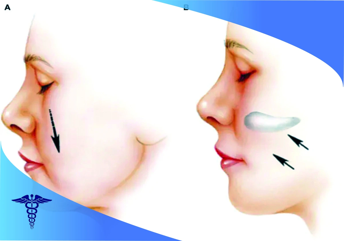 اقدامات پیش و پس از انجام جراحی پروتز گونه