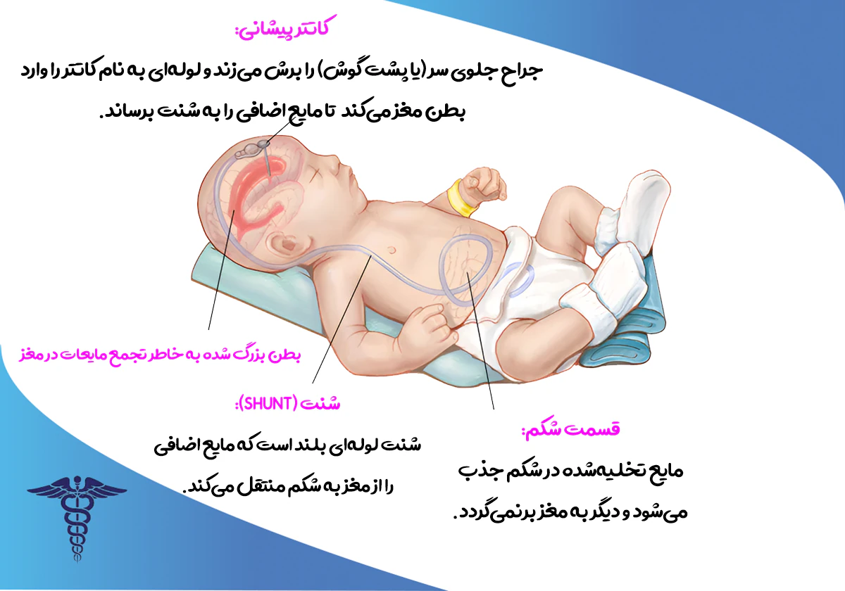 نحوه جراحی شنت مغزی کودک برای درمان آب آوردن مغز