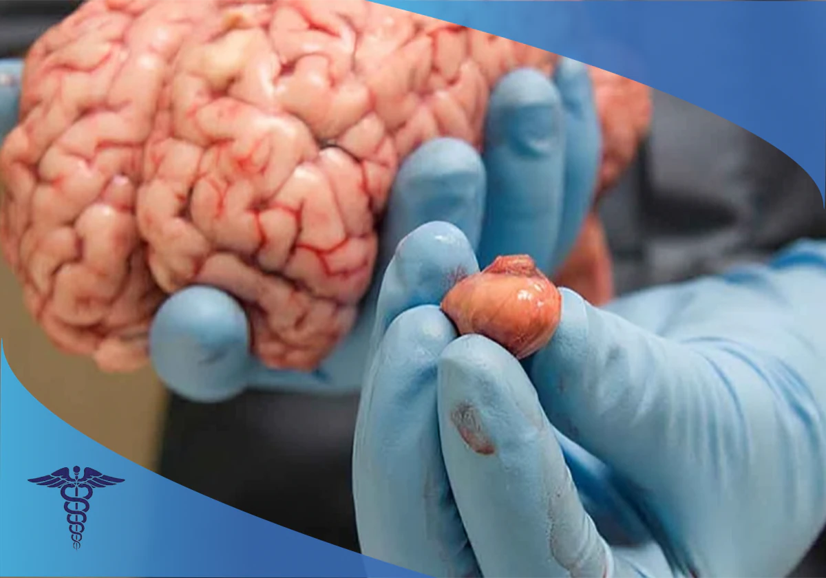 درمان تومور مغزی در شیراز