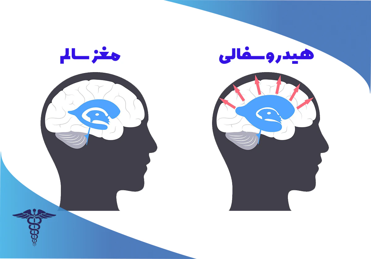 درمان هیدروسفالی بزرگسالان شیراز
