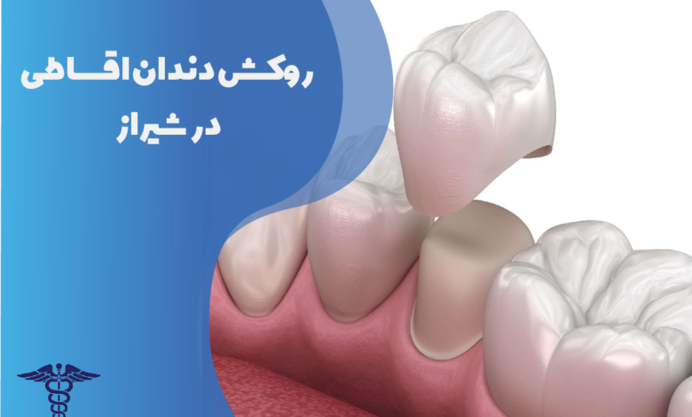 روکش دندان اقساطی در شیراز