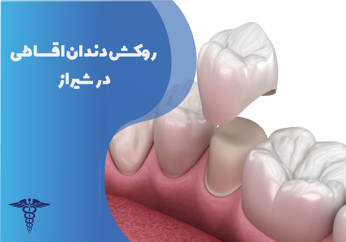 روکش دندان اقساطی در شیراز